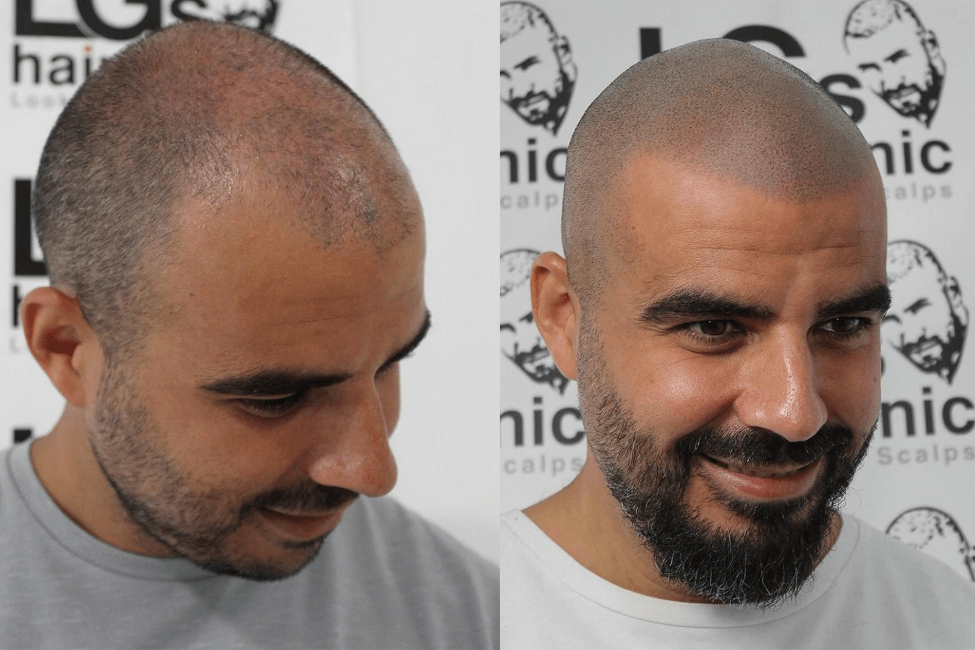 scalp micropigmentation